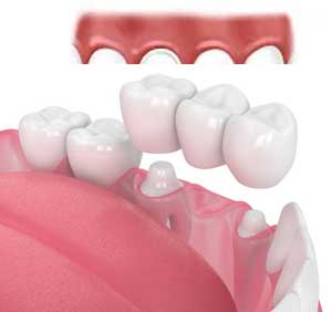 3d render of jaw with dental bridge over white background